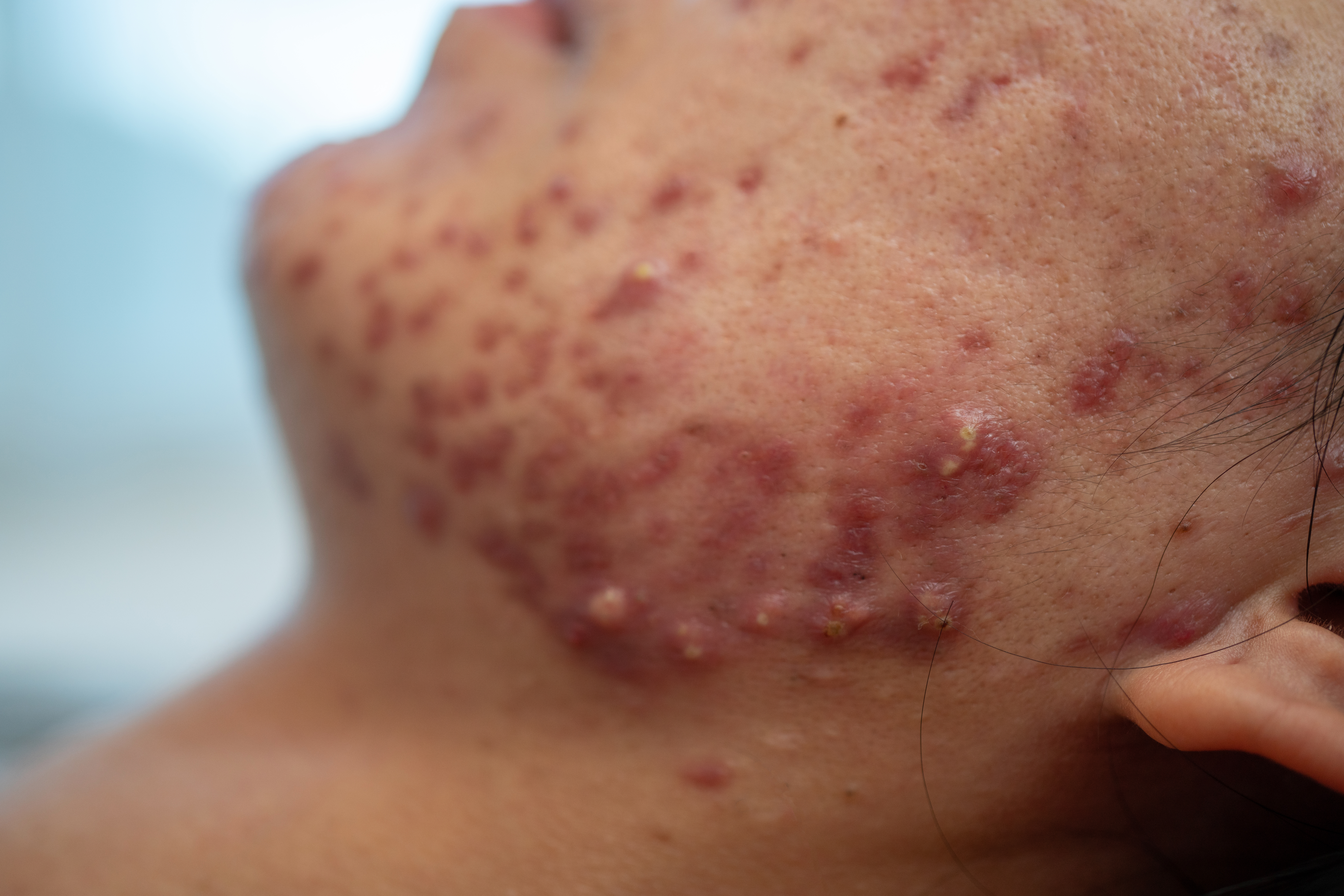 Acne on face because the disorders of sebaceous glands productions. Acne or a Cosmetic Allergy. Hormonal changes and Foods Cause Symptoms of Skin Allergies