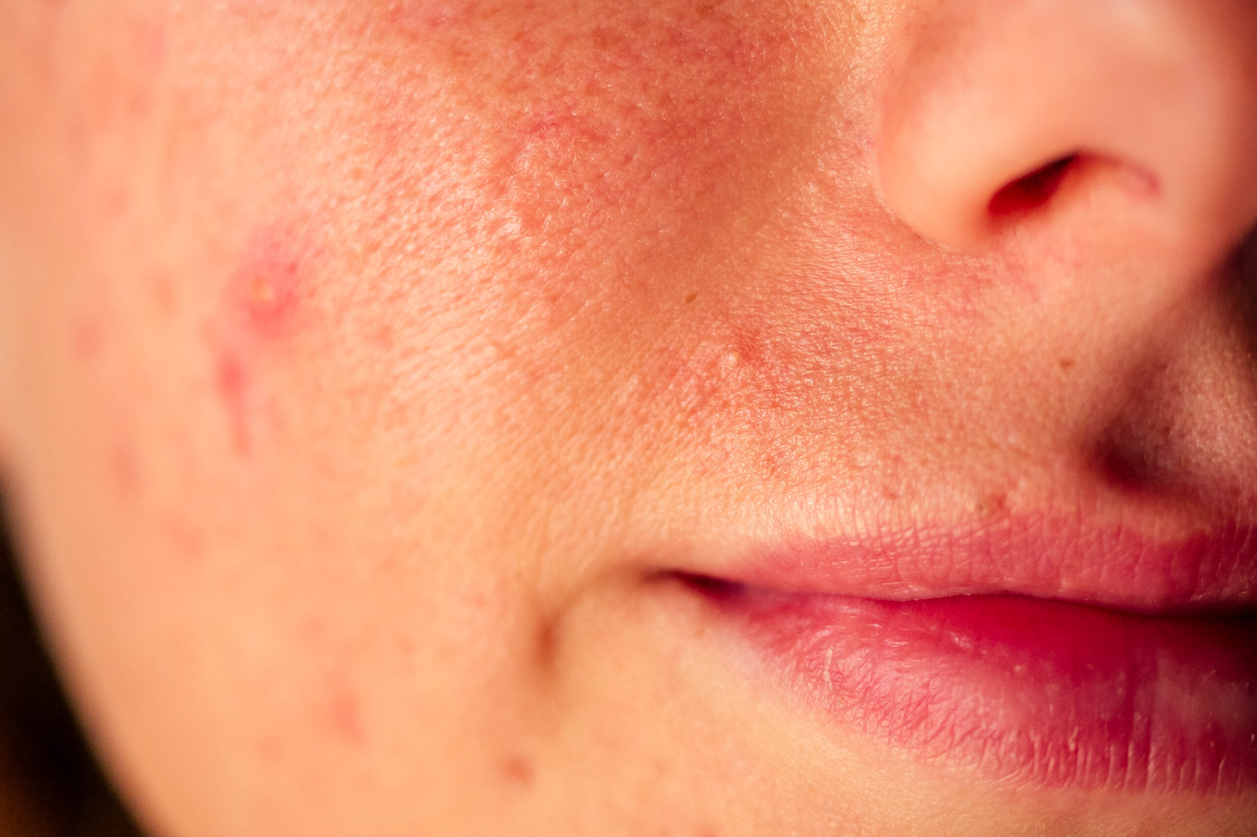 post-acne, scars and red festering pimples on the face of a young woman. concept of skin problems and harmonic failure.