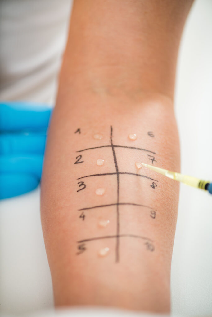 Allergy - Skin Prick Testing