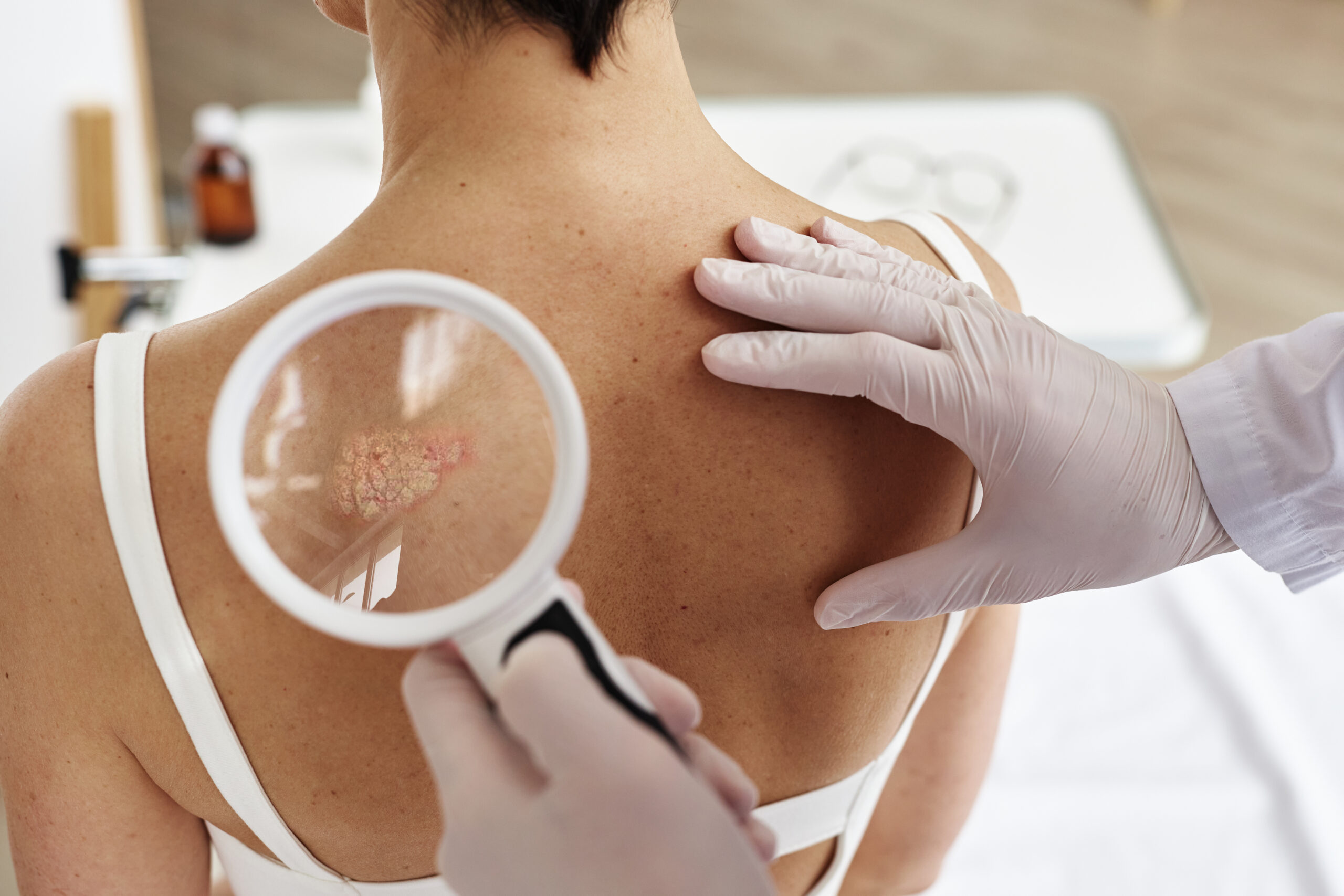 Close up of doctor holding magnifying glass while examining back of female patient with rash spots in dermatology clinic, copy space