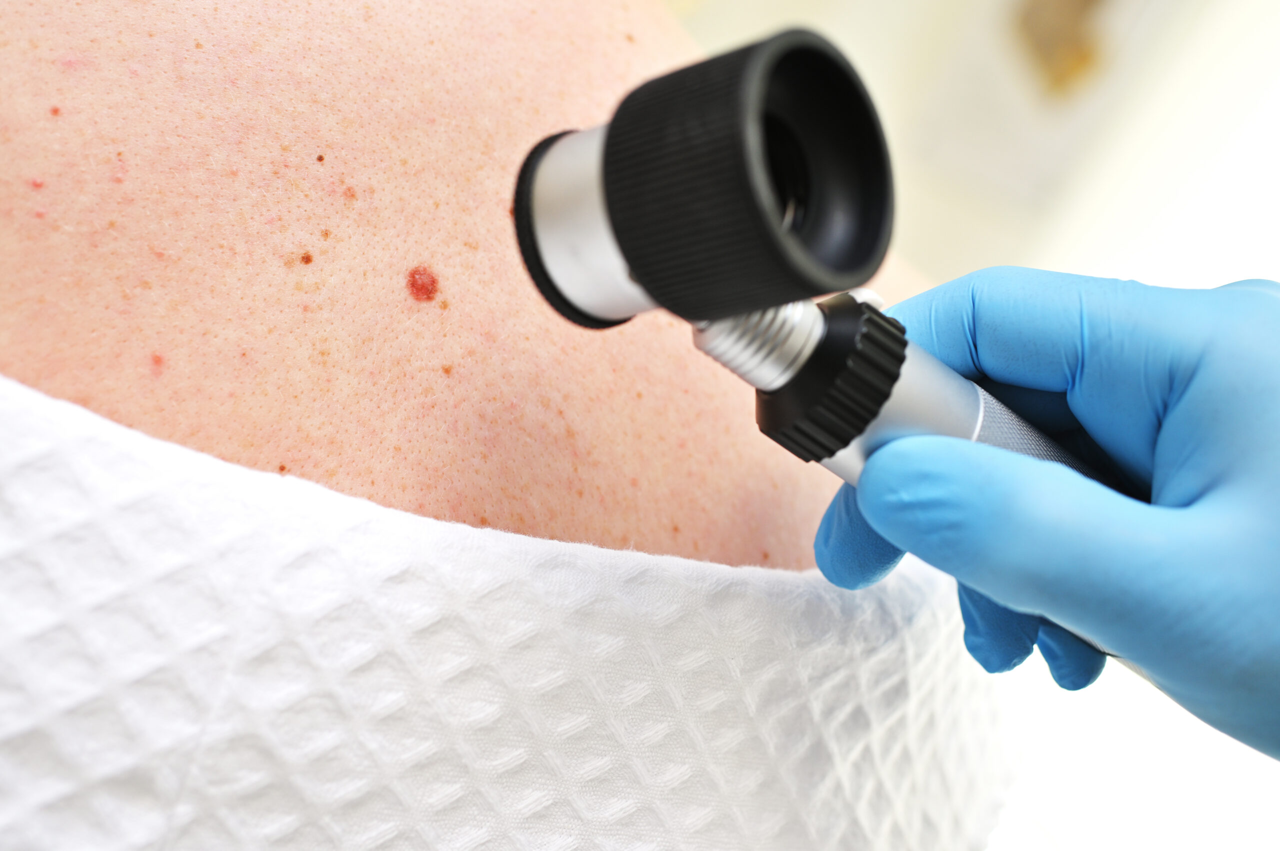 A dermatologist oncologist uses a dermatoscope to examine moles and birthmarks on the patient's body. Melanoma Day, Skin Cancer