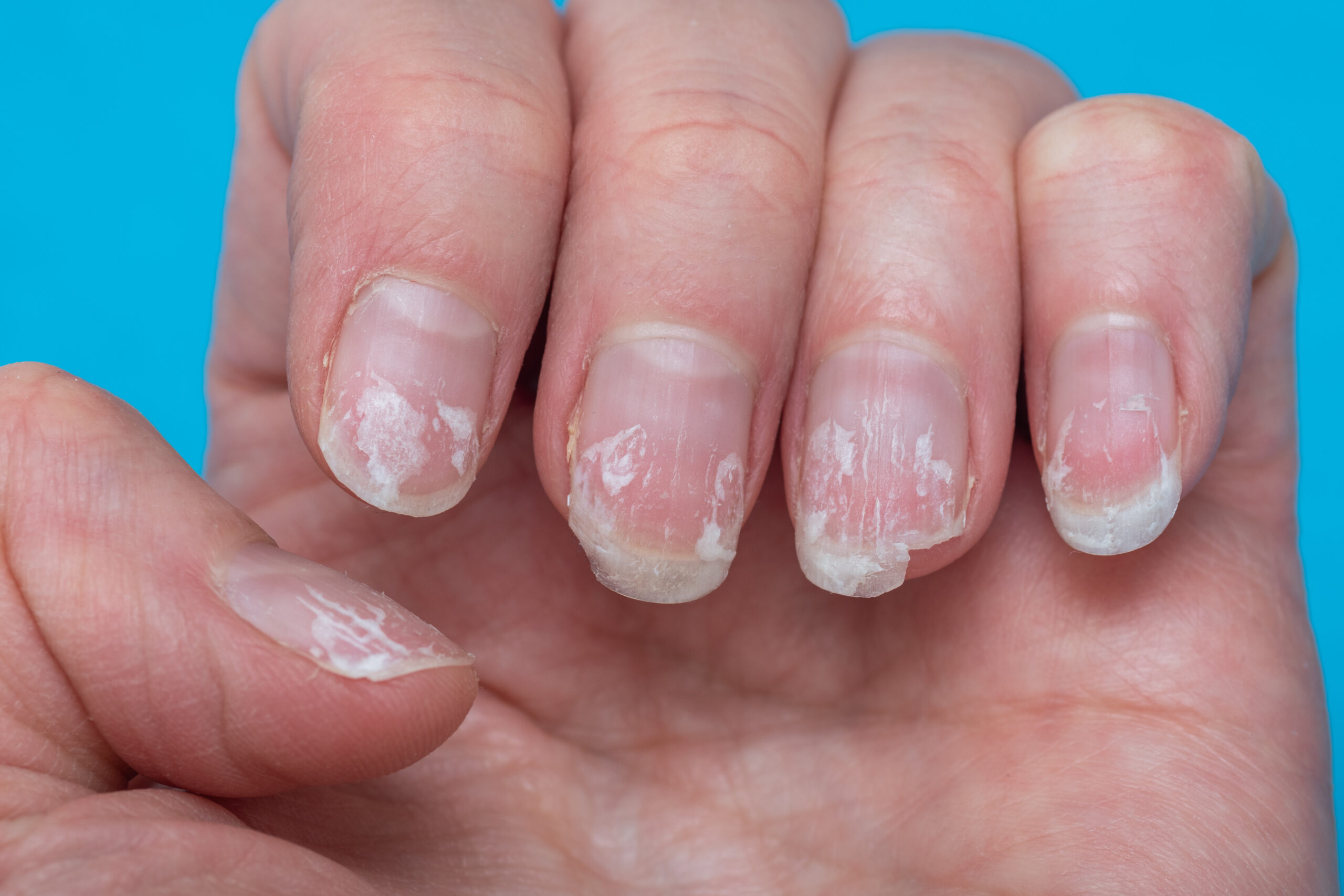 Flaky bitten and brittle nails without a manicure. Regrown nail cuticle and damaged nail plate after gel polish on blue background.