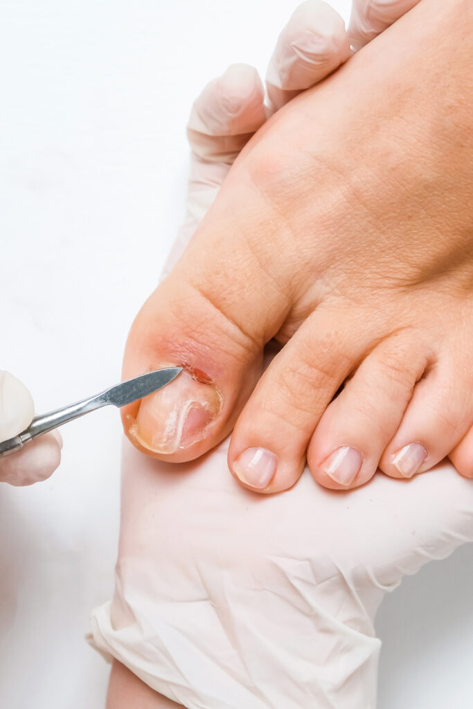 Pedicure, podologist. Patient on medical pedicure procedure, nail disease, cholesis detachment of the nail plate. Foot care, treatment in a medical spa salon.